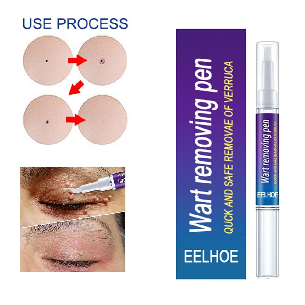 EELHOE Skin Tag & Wart Remover Pen - Fast & Effective