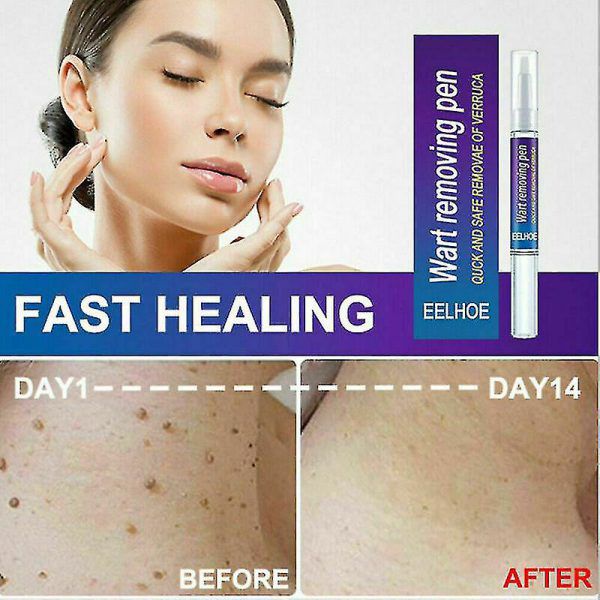 EELHOE Skin Tag & Wart Remover Pen - Fast & Effective